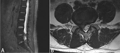 Analysis of preoperative and postoperative depression and anxiety in patients with lumbar disc herniation with radiculopathy treated with percutaneous transforaminal endoscopic discectomy